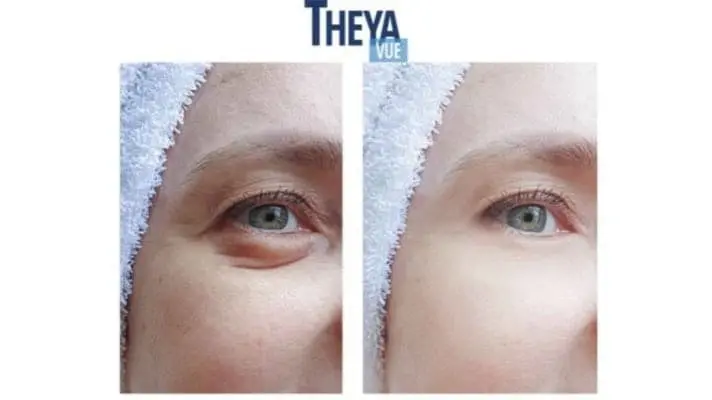 theyavue before and after results